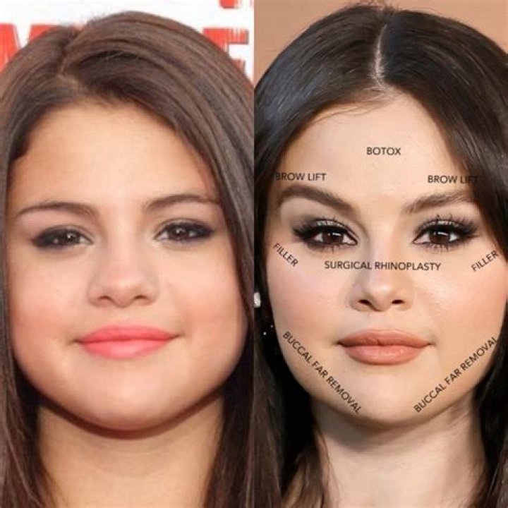 Selena Gomez Plastic Surgery: The Truth Behind the Rumors